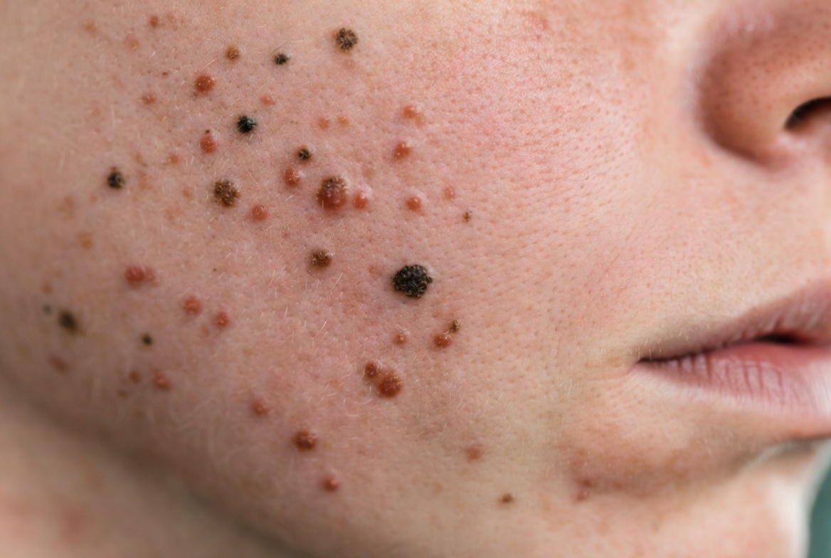 Come sbarazzarsi dell'acne: trattamenti efficaci e consigli utili