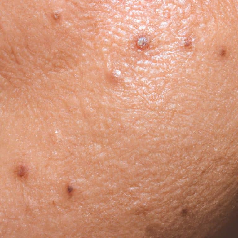 Discover the Secret to Clear Skin: The Ultimate Guide to Banishing Acne